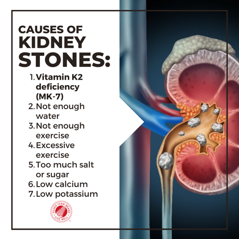 Kidney stones kill, vitamin K2 has clinically been shown to help - K2D3, calcium, bone health